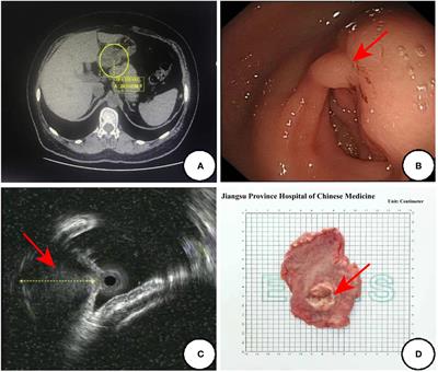 Gastroblastoma: a case report and literature review